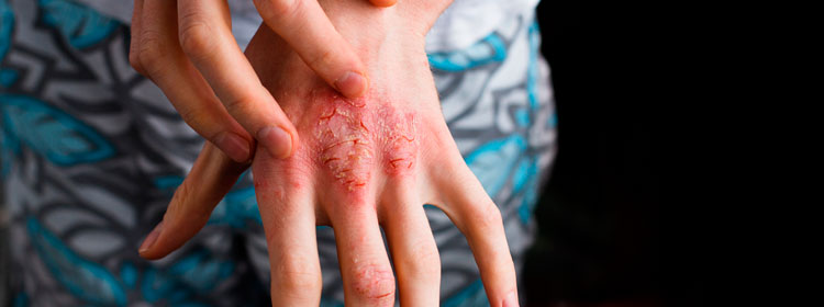 Claves para proteger tu piel de la dermatitis atópica