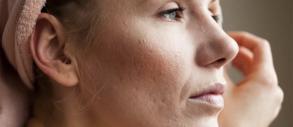 Derribando mitos: cuestión de acné