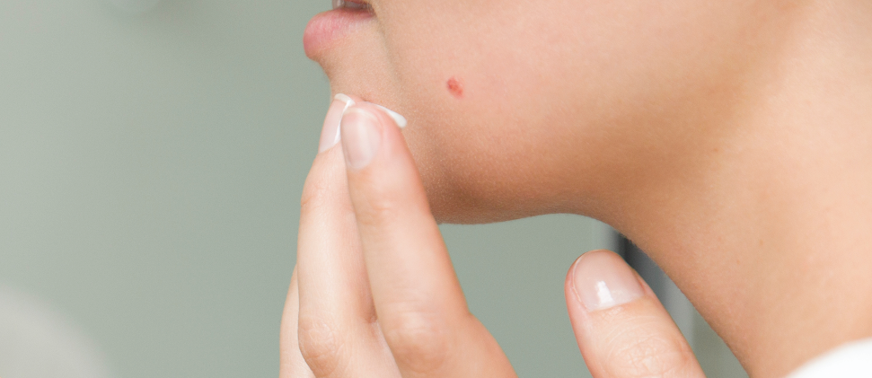 ¿Cómo tratar y cuidar la piel ante una quemadura, una pequeña herida o irritación en la piel?